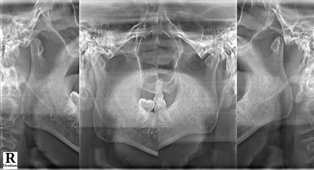 50대 남성 환자의 비식별 턱관절 방사선 검사 이미지