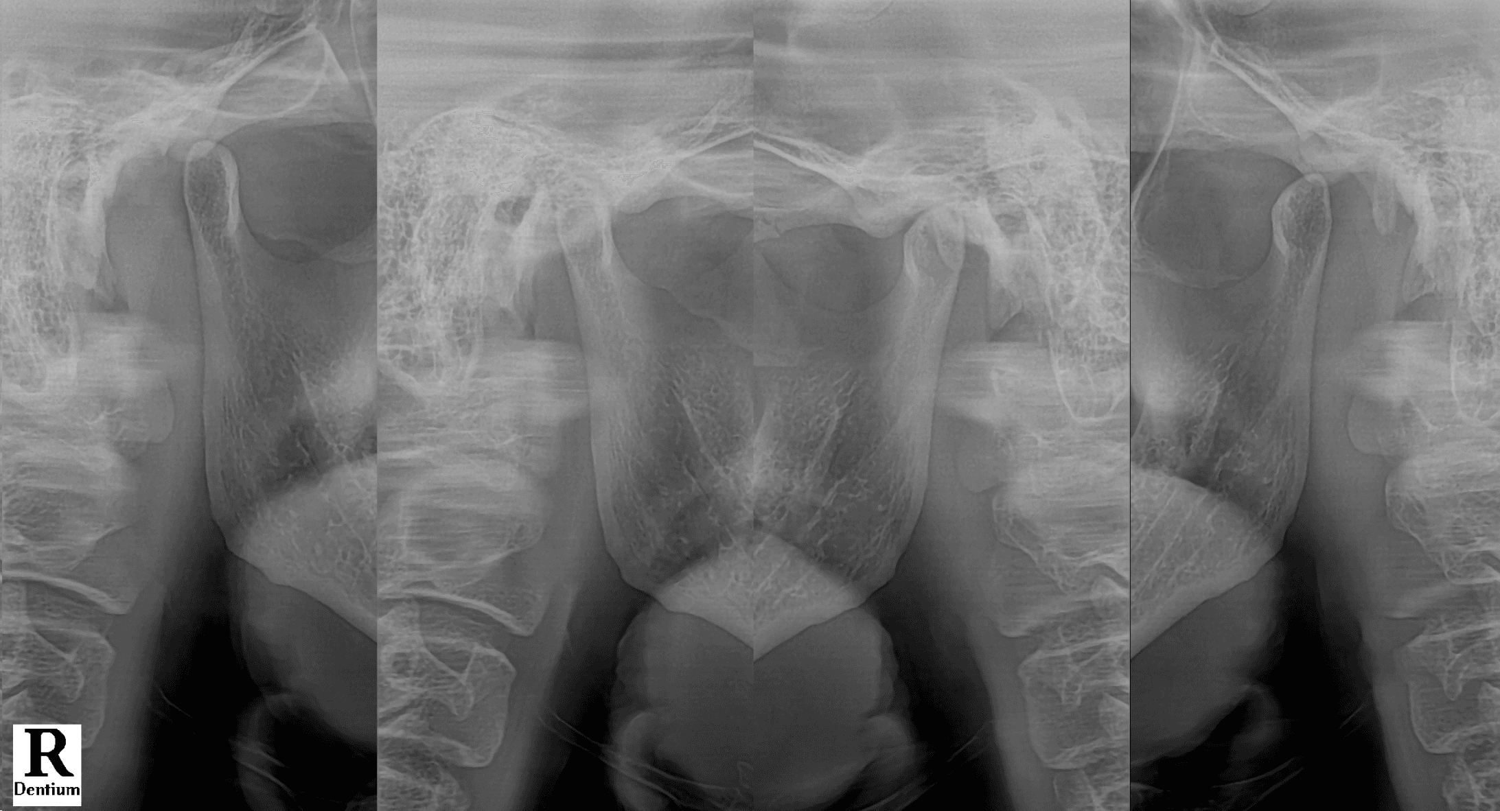 얼굴과 눈, 귀, 턱과 목 주변 통증으로 내원한 50대 남성 환자의 비식별 턱관절 방사선 사진