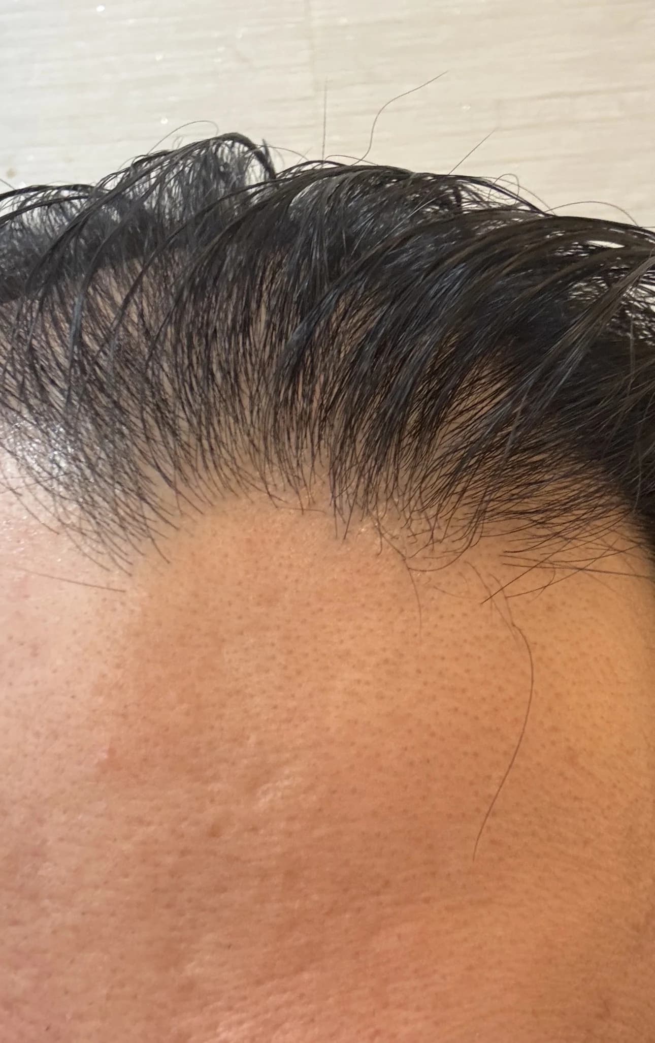 부드러운 구강내장치를 사용한 다음 날 선상 함몰이 뚜렷하게 보이지 않는 상태를 촬영한 비식별 이마 사진
