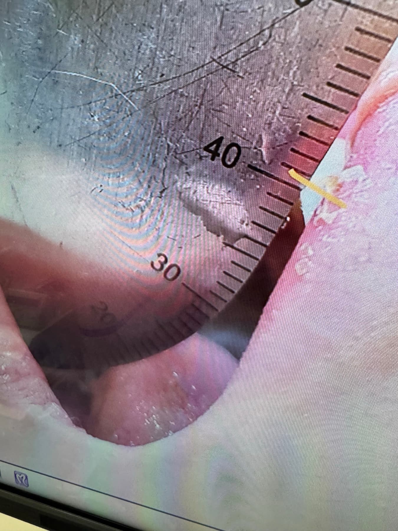 둘째 날 치료 후 최대 개구량 40mm를 자로 측정한 비식별 구강 사진