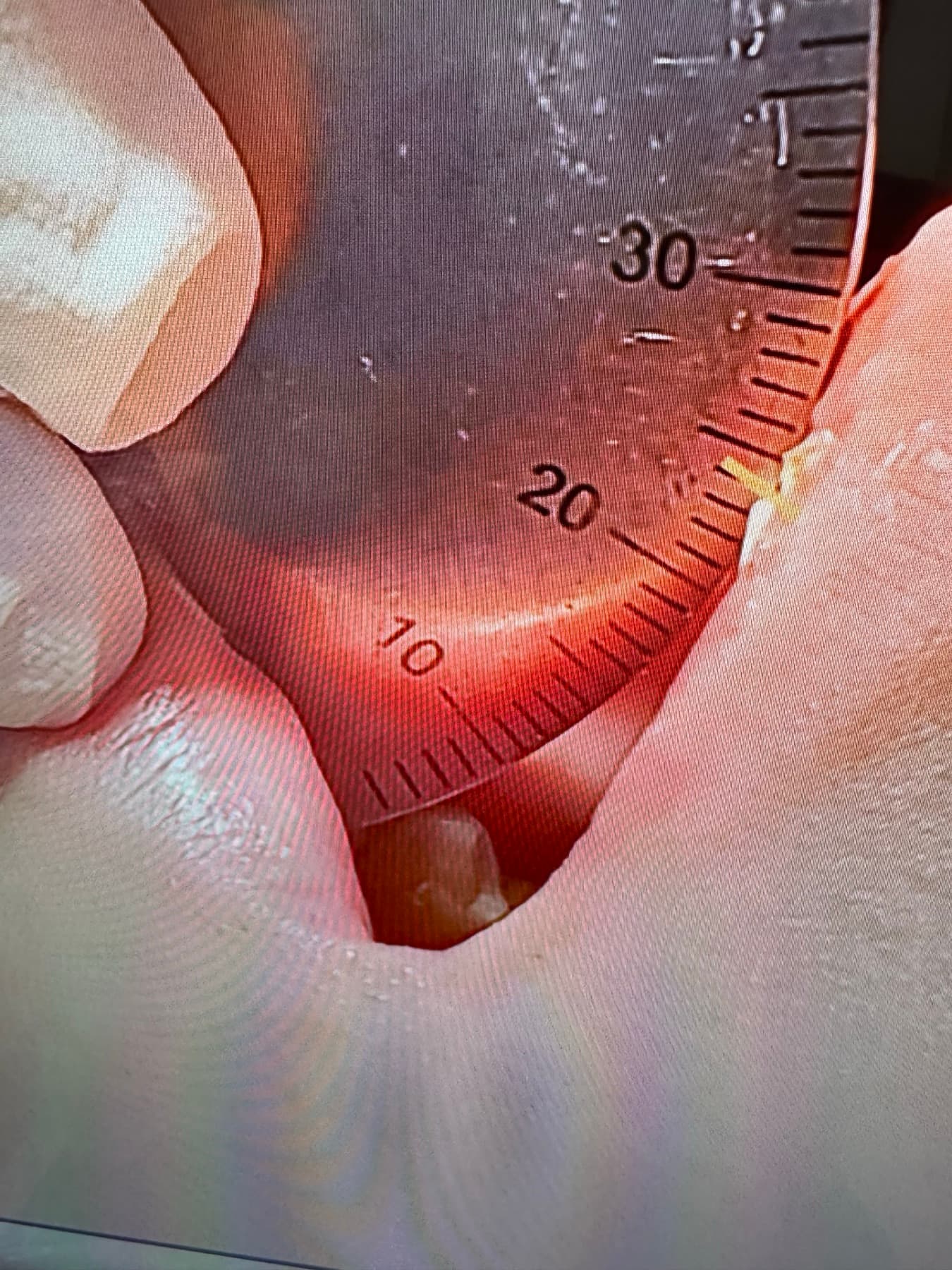둘째 날 치료 전 최대 개구량 22mm를 자로 측정한 비식별 구강 사진