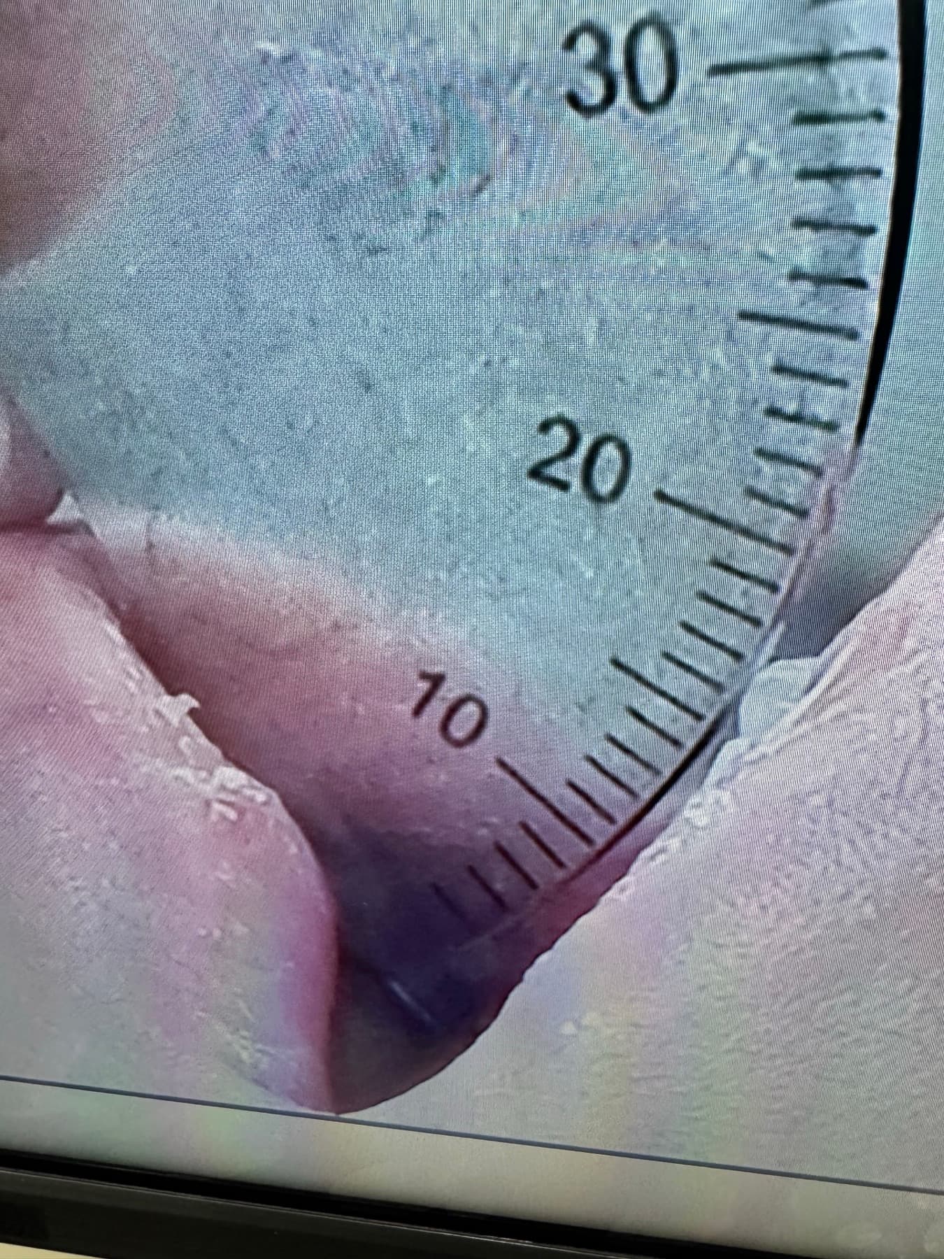 첫날 최대 개구량 17mm를 자로 측정한 비식별 구강 사진