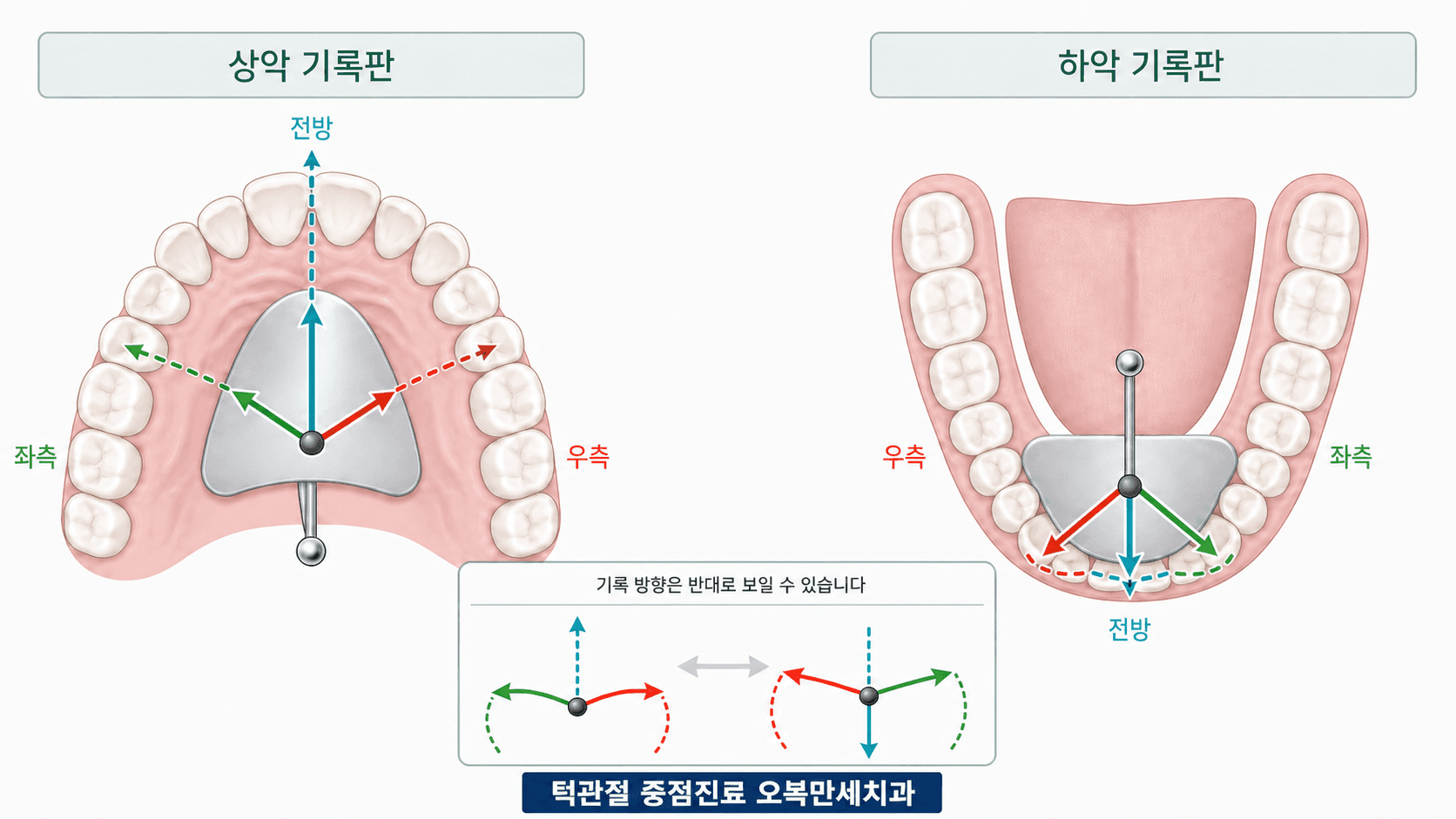 상악 기록판과 하악 기록판에서 고딕 아치 트레이싱 방향이 반대로 보일 수 있음을 비교한 교육 그림
