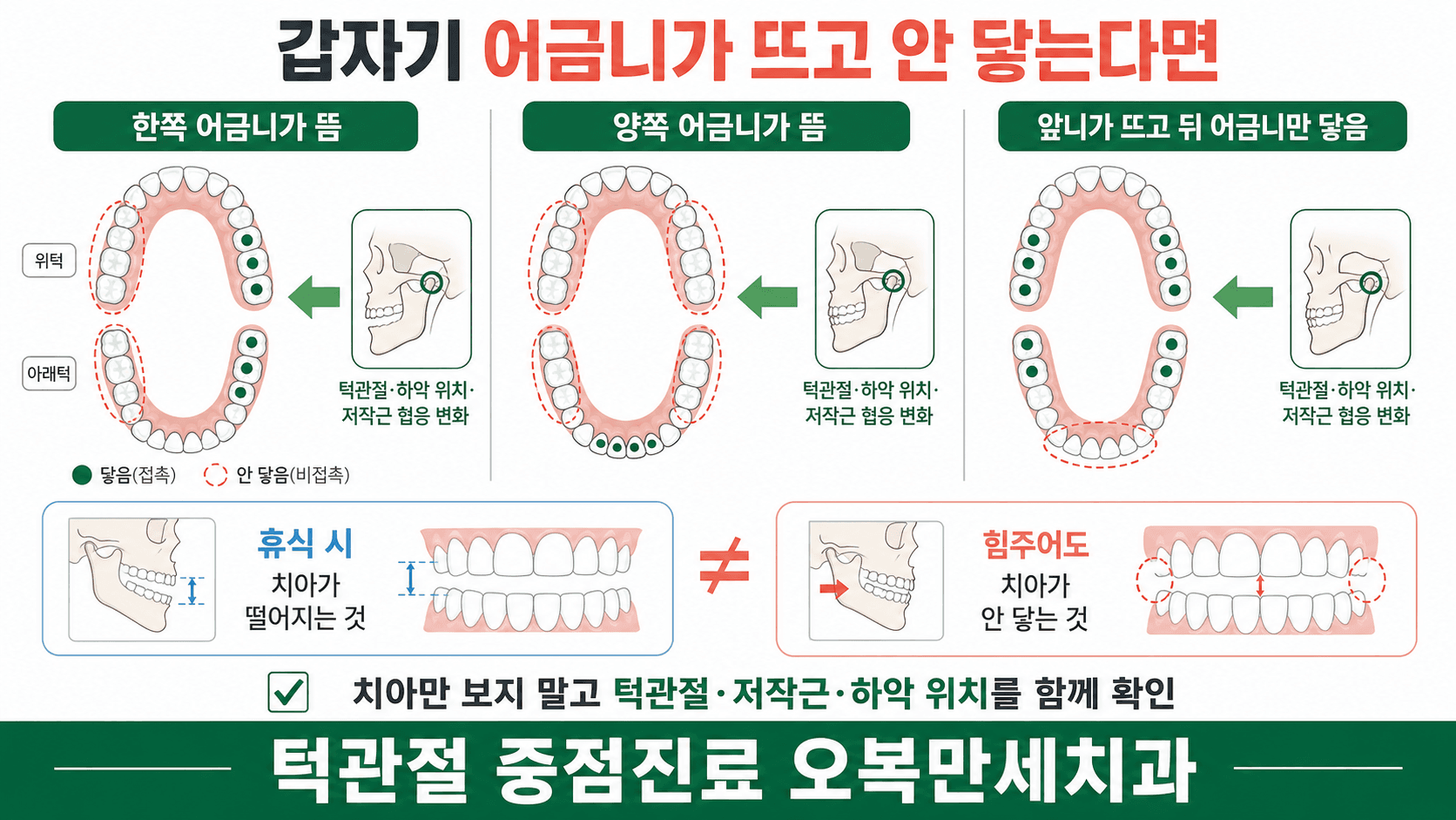 한쪽 어금니와 양쪽 어금니, 앞니가 뜨는 급성 교합 변화를 턱관절과 저작근 상태에 따라 구분하는 그림