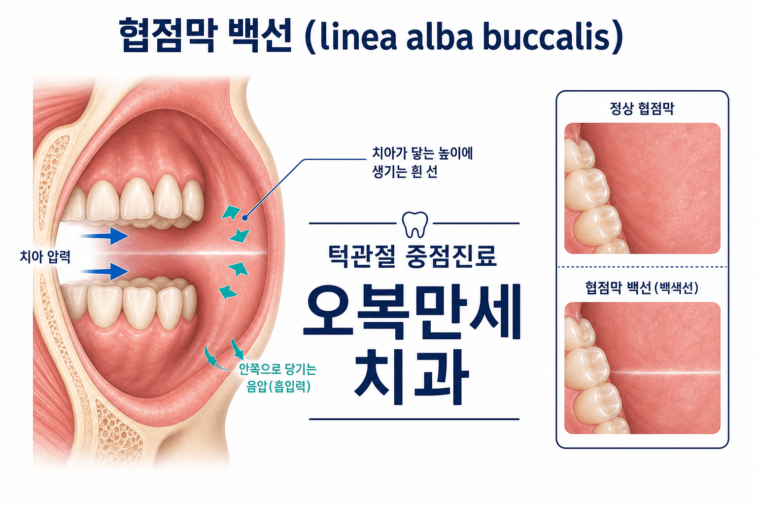 볼 안쪽 치아가 닿는 높이에 생기는 협점막 백선과 이악물기·마찰의 관계를 설명하는 오복만세치과 인포그래픽