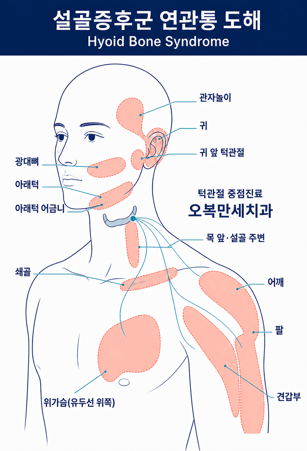 설골 큰뿔에서 같은 쪽 얼굴, 목, 어깨와 위가슴으로 이어질 수 있는 연관통 범위를 재구성한 설명 도해