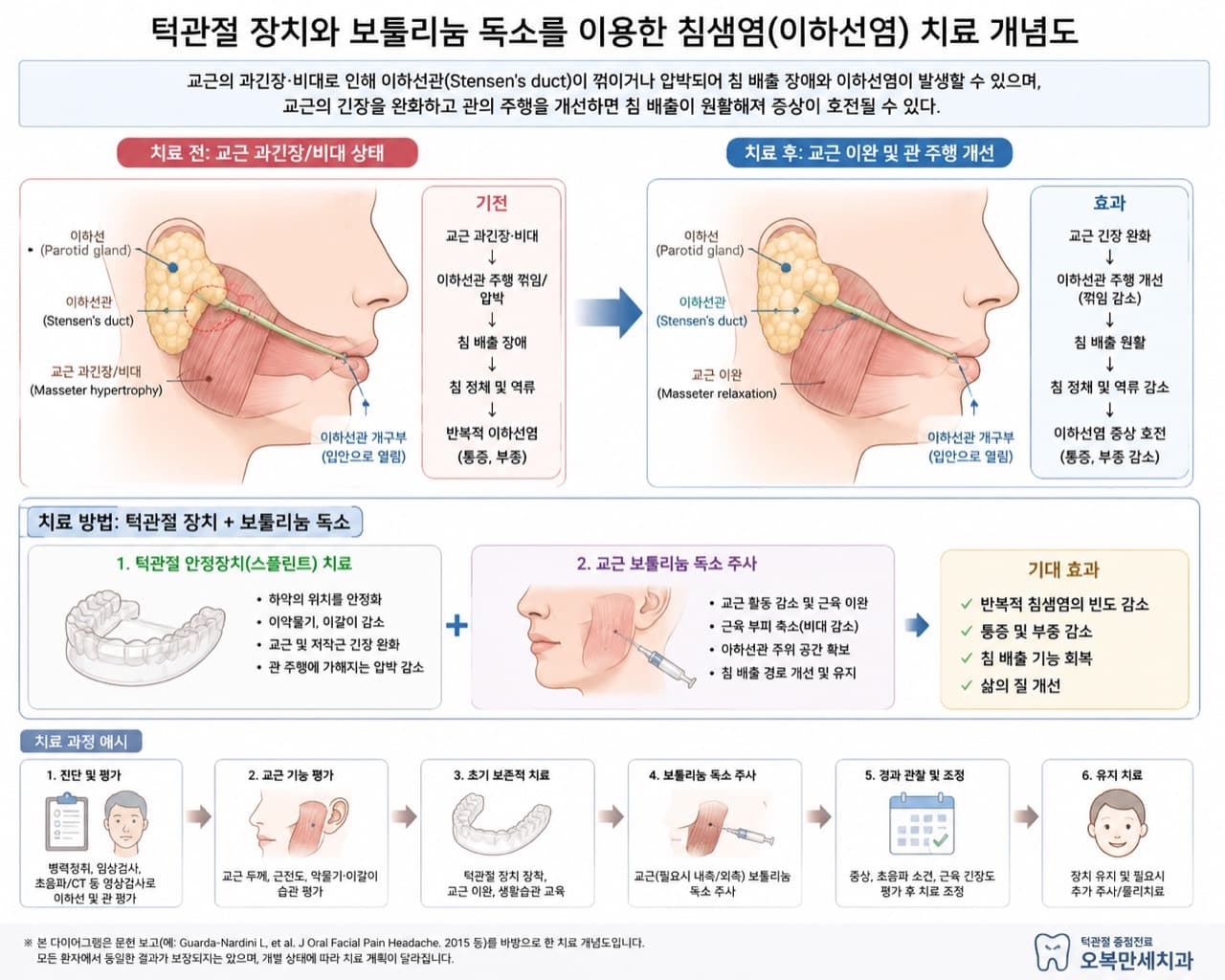 교근 과긴장과 비대로 이하선관이 압박되거나 꺾일 때 턱관절 장치와 교근 보톡스(보툴리눔 독소) 치료로 교근 이완과 침 배출 개선을 설명하는 개념도