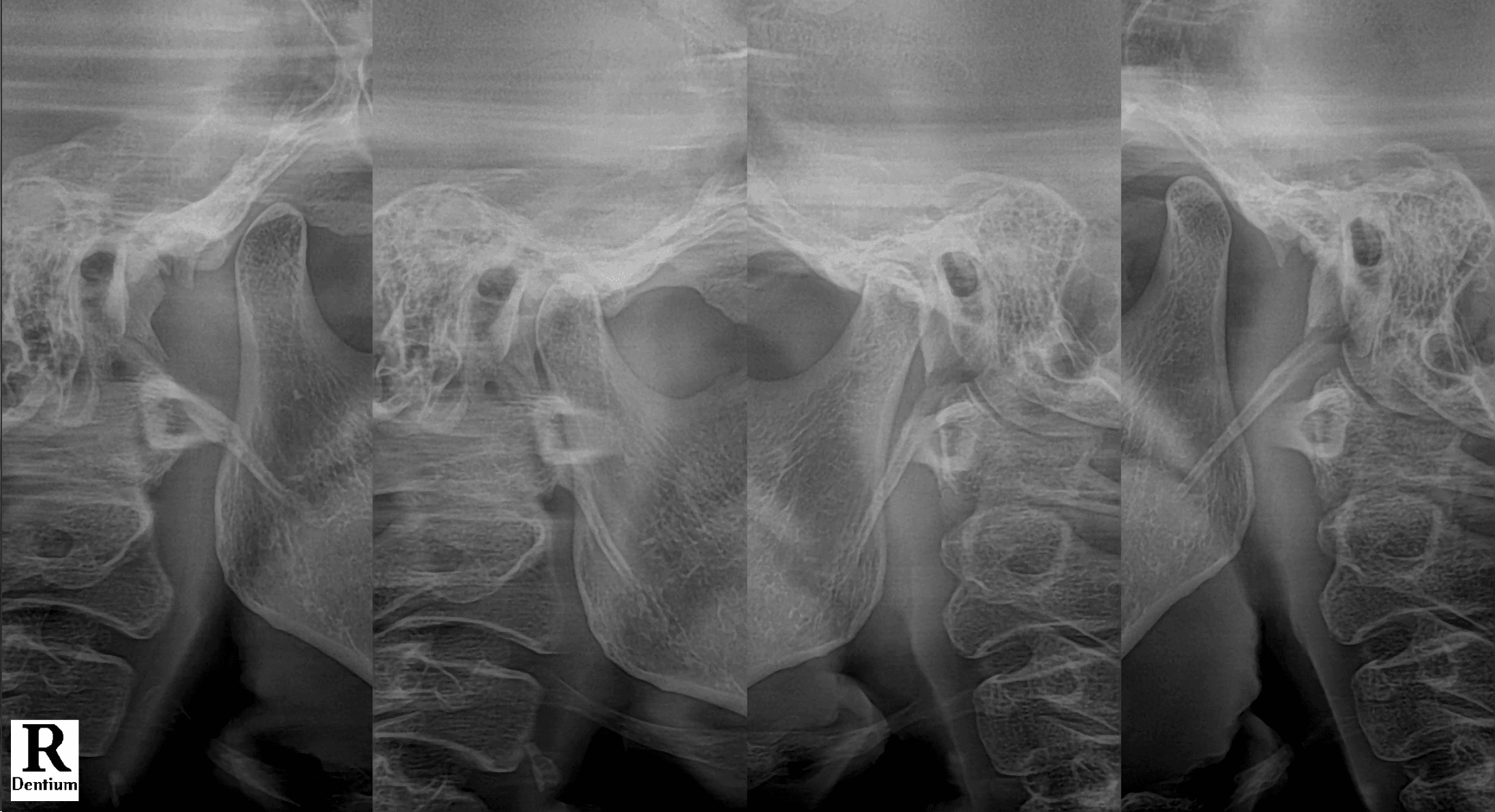 이비인후과 검사에서 이상이 없었지만 왼쪽 귀 뒤 통증과 아래 치아 시림을 호소한 환자의 비식별 턱관절 방사선사진