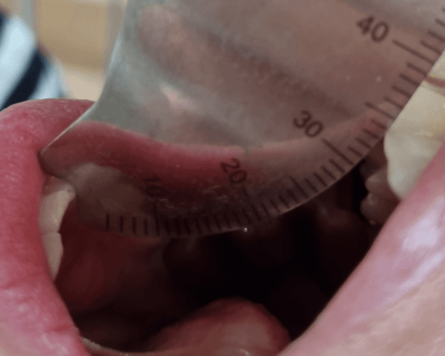 두 번째 비식별 환자의 치료 경과 중 약 35mm 개구량 기록사진