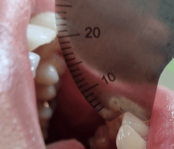 두 번째 비식별 환자의 초진 당시 약 20mm 개구량 기록사진
