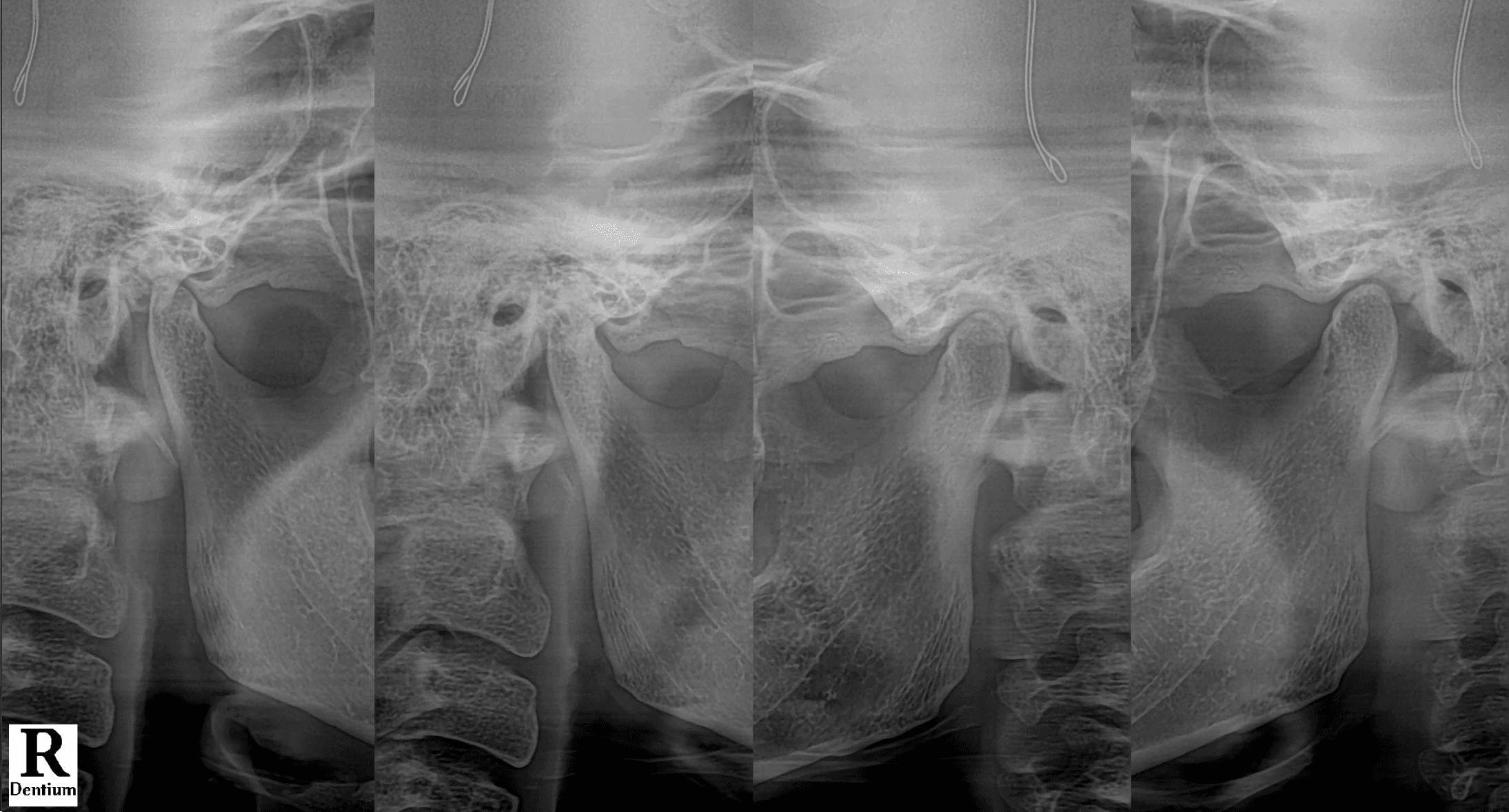 스플린트 제작을 기다리며 개구제한 치료를 병행한 두 번째 비식별 환자의 턱관절 방사선사진