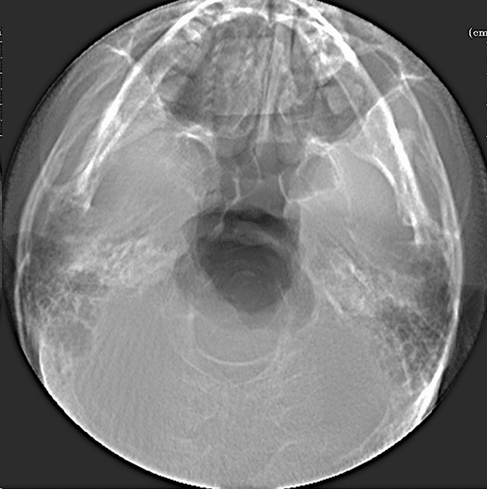 비식별 환자의 두개저와 아래턱을 하방에서 촬영한 방사선 검사 자료