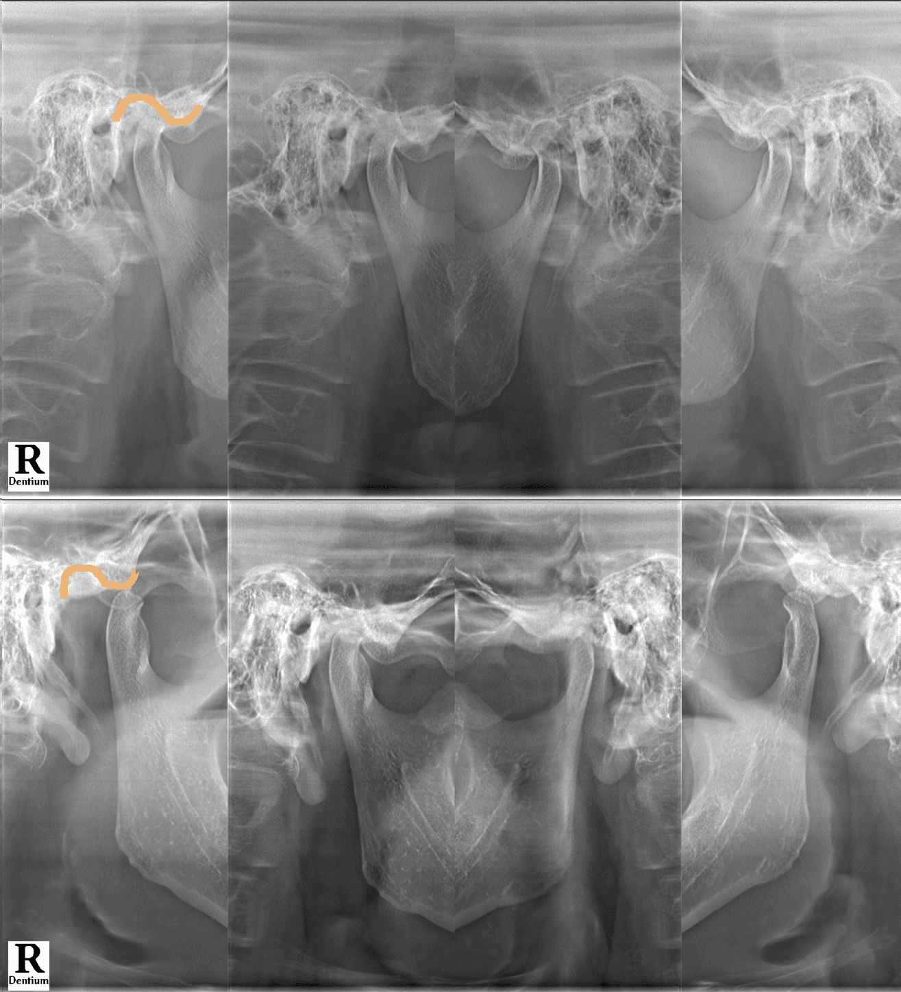 비식별 환자의 좌우 턱관절을 여러 위치에서 촬영한 방사선 검사 자료