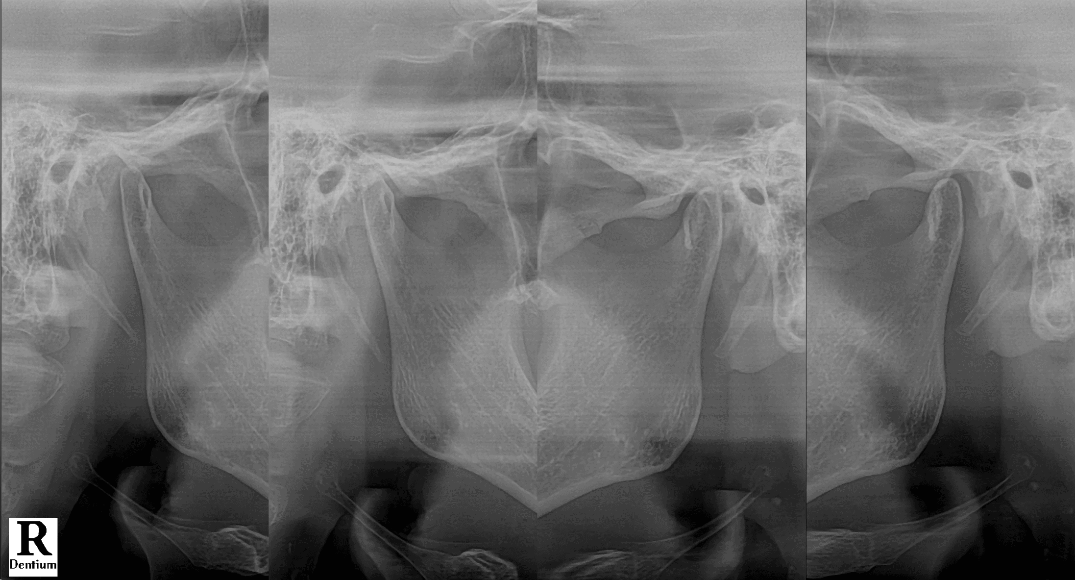 왼쪽 턱 소리와 입 벌림·씹기 통증, 기침할 때 왼쪽 귀 통증을 호소한 환자의 비식별 턱관절 방사선 사진
