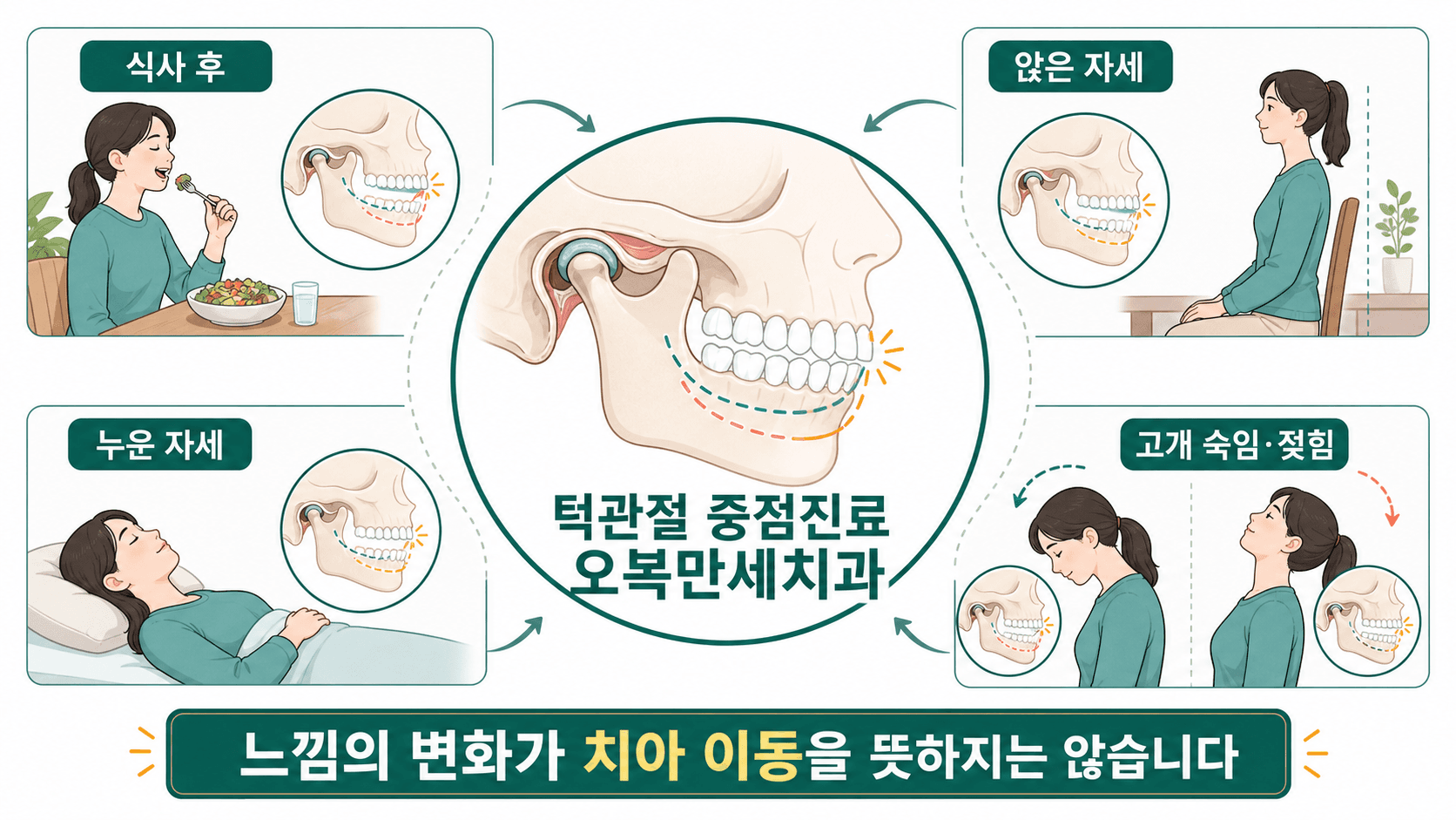 식사 후와 앉은 자세, 누운 자세, 고개 숙임과 젖힘에 따라 턱 위치와 교합 느낌이 달라질 수 있음을 설명하는 일러스트