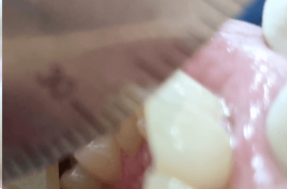 첫 치료 뒤 입 벌림 거리를 다시 측정하는 비식별 구강 사진