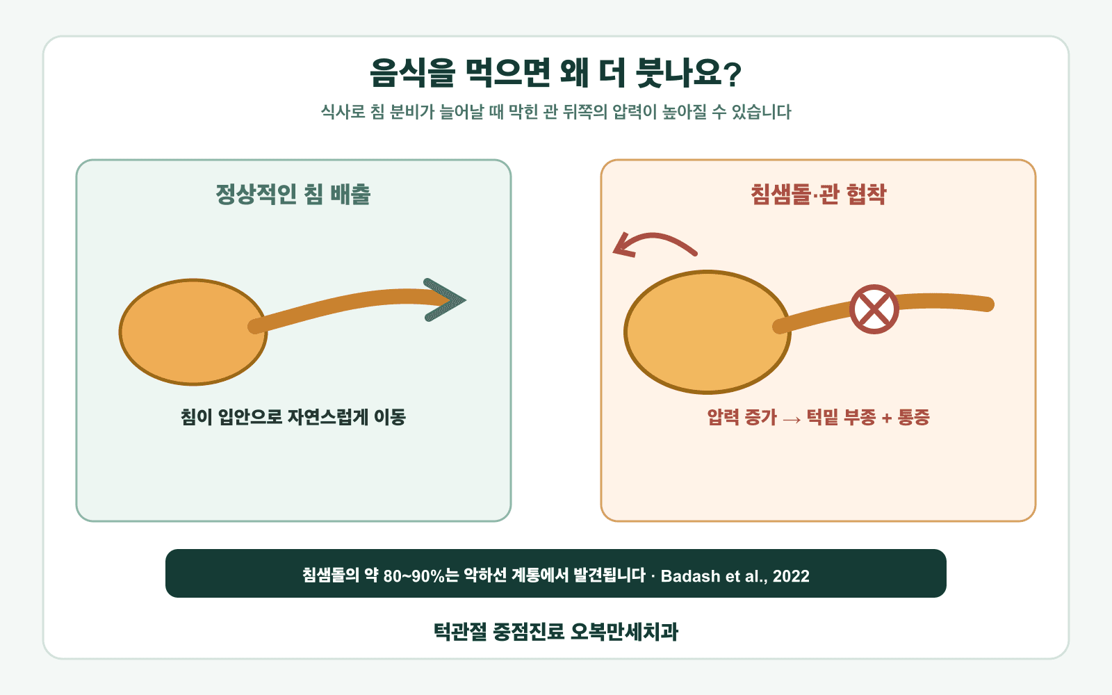 정상적인 침 배출과 침샘돌 또는 관 협착으로 식사할 때 턱밑이 붓는 과정을 비교한 의료 일러스트