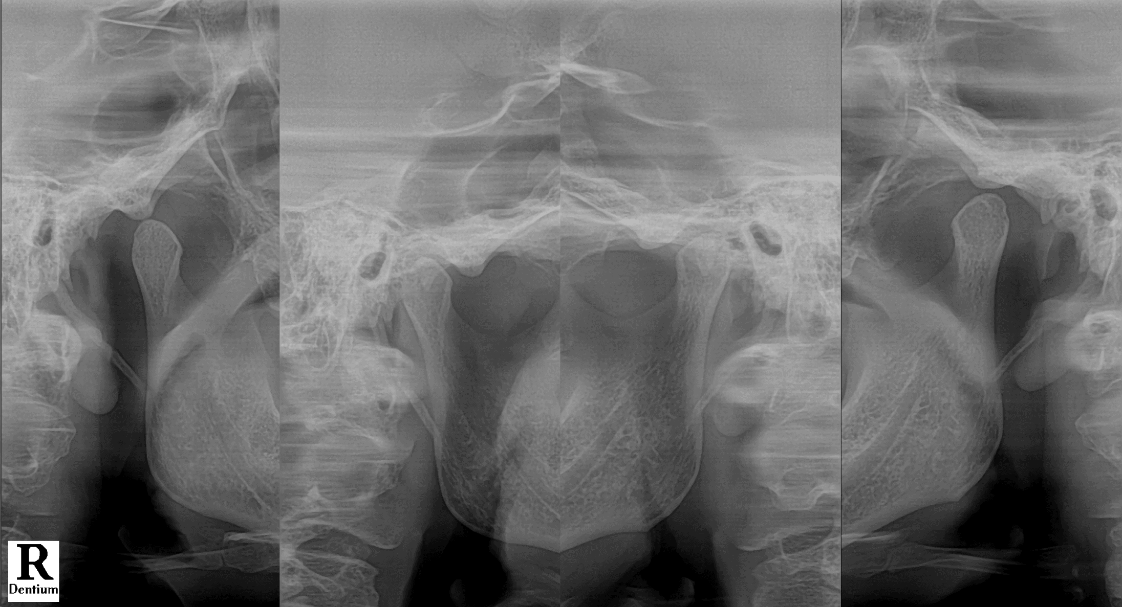 왼쪽 턱과 귀 통증, 눈의 뻑뻑함을 호소한 환자의 턱관절 방사선사진