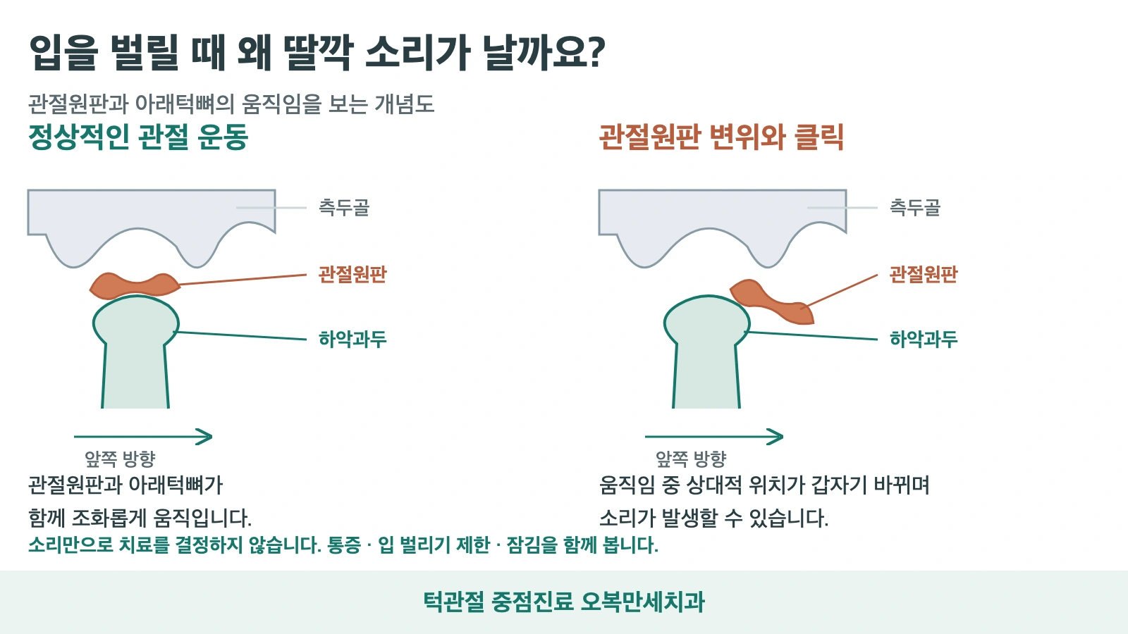 정상적인 턱관절 운동과 관절원판의 상대적 위치 변화로 생길 수 있는 클릭을 비교한 일반 개념도