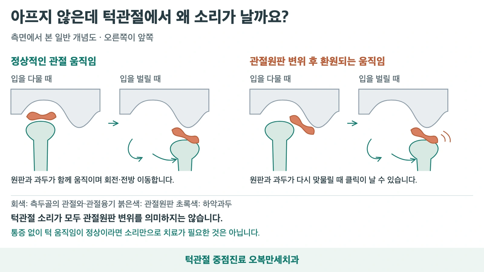 정상적인 턱관절 운동과 환원성 관절원판 변위에서 입을 벌리는 동안 클릭이 생길 수 있는 과정을 비교한 일반 개념도